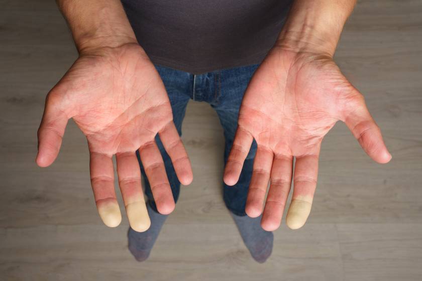 baume-tigre-syndrome-de-raynaud