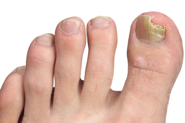 Baume du tigre mycose ongle : efficacité controversée à examiner