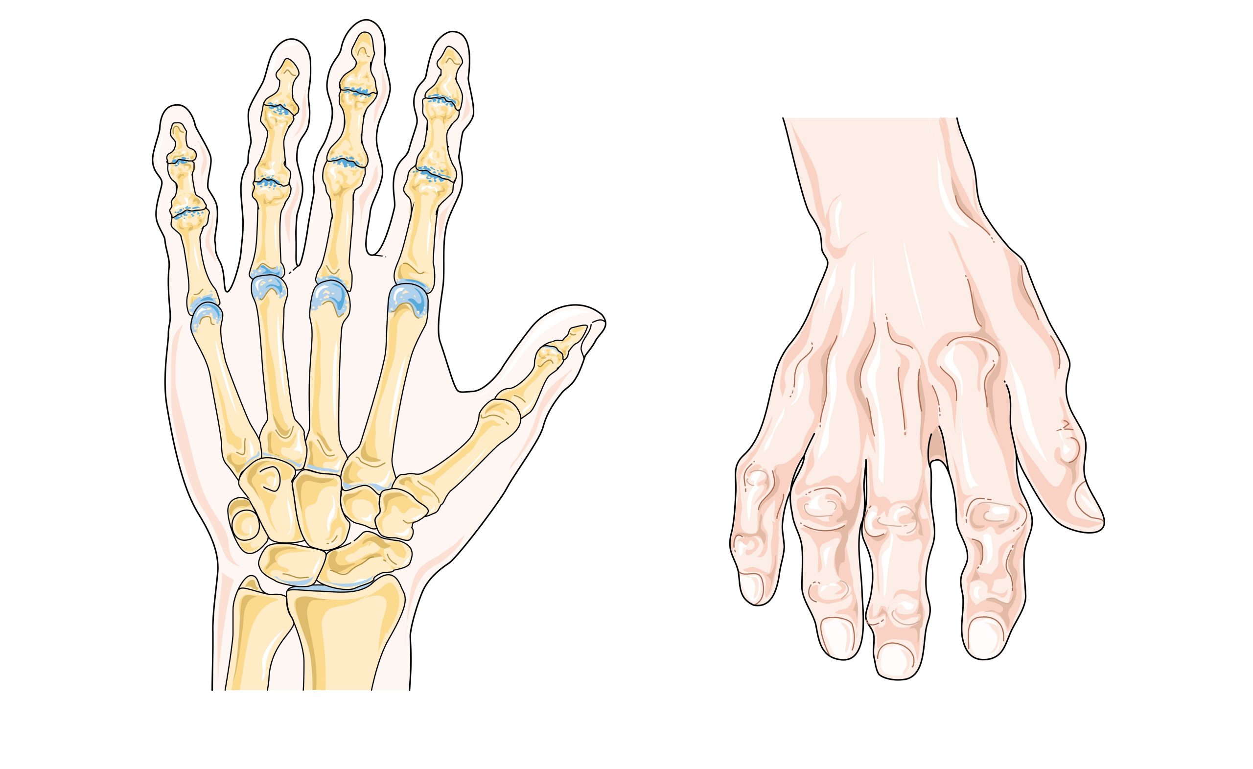 Baume du tigre arthrose : action sur les douleurs articulaires